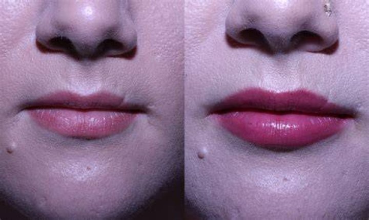 Is Silikon 1000 safe for lips?