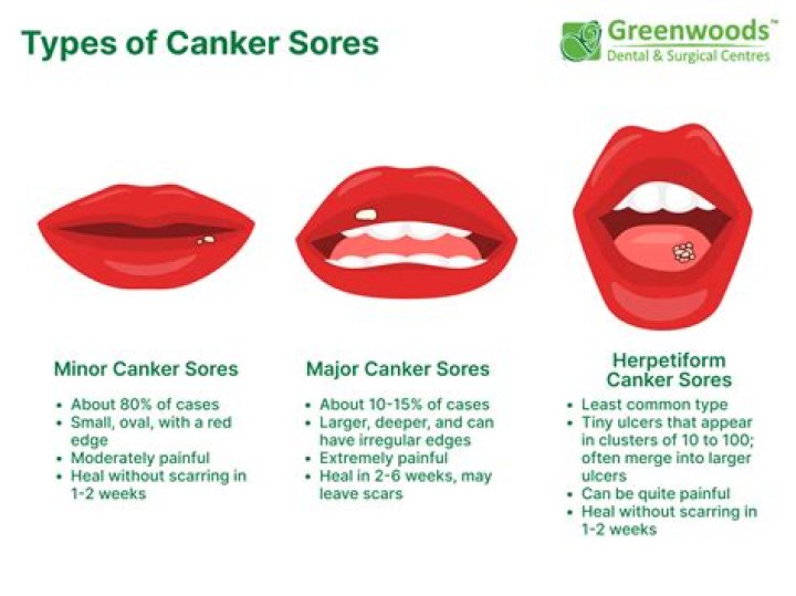 What are the stages of canker sores?