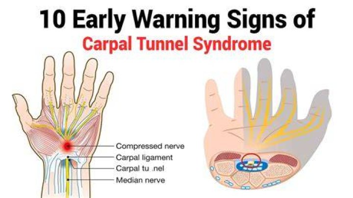 What are the warning signs of carpal tunnel syndrome?